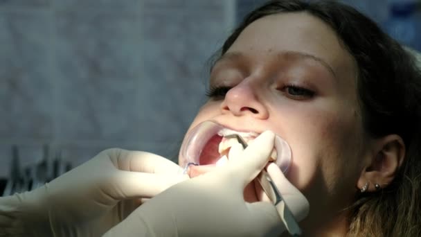 El dentista coloca la lana de algodón en la boca del paciente y seca los dientes antes de instalar el sistema de soporte de cerca. Visita al ortodoncista — Vídeos de Stock
