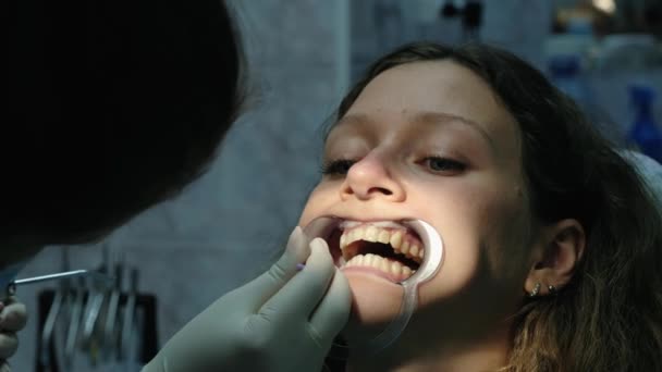 Tandarts zet de katoen in zijn mond aan het meisje vóór de behandeling en de installatie van de beugel systeem close-up. Bezoek aan de orthodontist. — Stockvideo