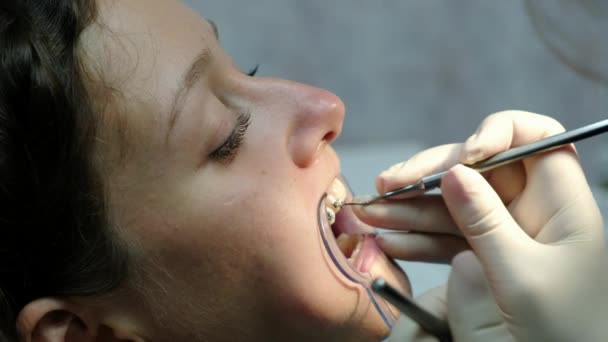 Návštěva zubaře, instalace systém držáků a oprava malocclusion. Ortodontista opravuje nastavení držáku a dívá do detail zubní zrcátka. — Stock video