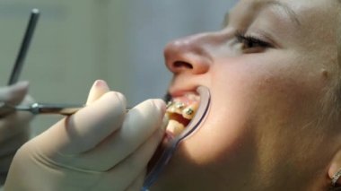 Dişçiye ziyaret edin. Demir parantez içinde onun ağız diş fiksatör bir kadınla için doktor ortodontist kurar yakın çekim.