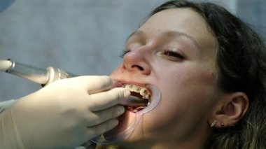 Yükleme metal diş teli yakın çekim, dişçi ziyareti. Ortodontist ısırık araçlarıyla düzeltir