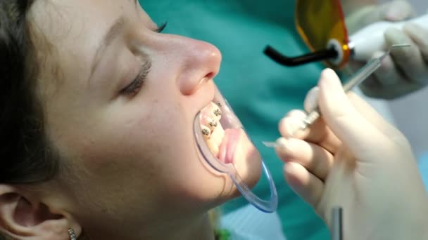 Installation de cordons métalliques à proximité. Visite chez le dentiste orthodontiste, correction de malocclusion, traitement des dents — Video