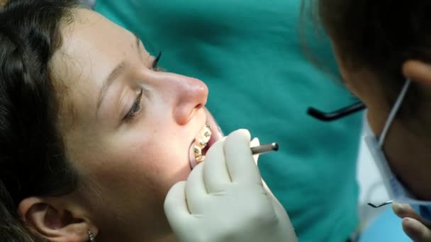 Instalación de tirantes metálicos de cerca. Visita al dentista ortodoncista, corrección de maloclusión, tratamiento de dientes — Vídeos de Stock