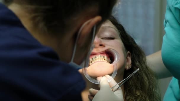 Установка металевих брекетів крупним планом, відвідування стоматолога. Ортодонт перевіряє встановлену систему брекетів на зубах — стокове відео