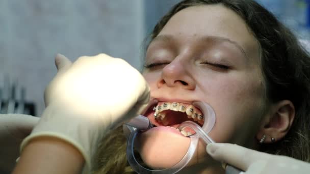 Installazione di bretelle metalliche primo piano, visita dal dentista. L'ortodontista corregge il morso . — Video Stock