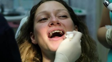 Metal diş telleri yakın çekim, dişçi ziyareti. Ortodontist kurulumu tamamlandı
