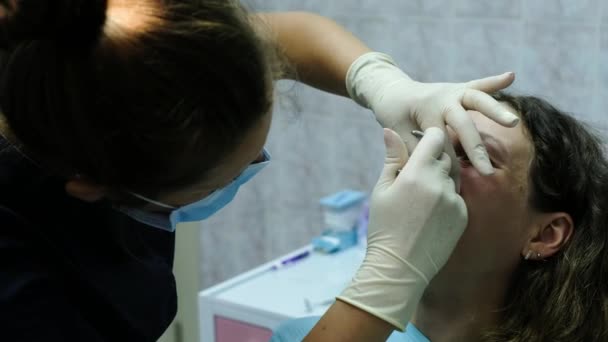 Bezoek aan de tandarts, installatie van het systeem van de beugel. Orthodontist stelt een metalen orthodontische boog en bijt uit met overtollige pincet — Stockvideo