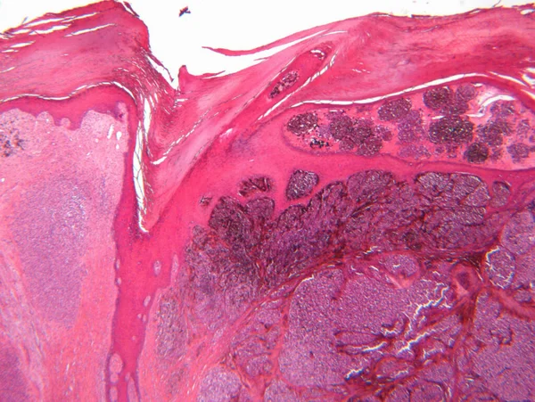 悪性黒色腫の顕微鏡像 — ストック写真