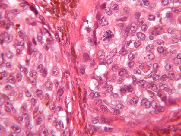 Mikroskopické Zobrazení Maligního Melanomu — Stock fotografie