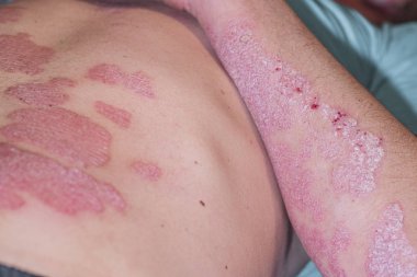 Bir hastalığı sedef adamla