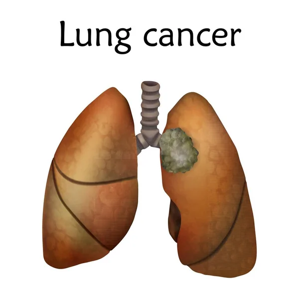 白色背景下肺癌的概念说明 — 图库照片