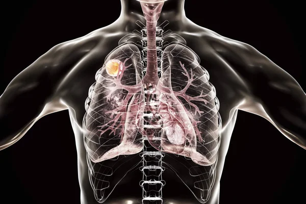 Enfermedad Aspergiloma Pulmonar Ilustración Digital —  Fotos de Stock