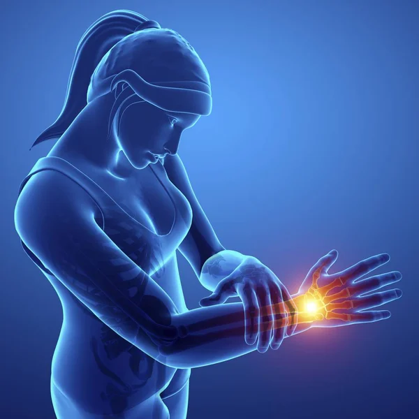 Female Silhouette Wrist Pain Digital Illustration — Stock Photo, Image
