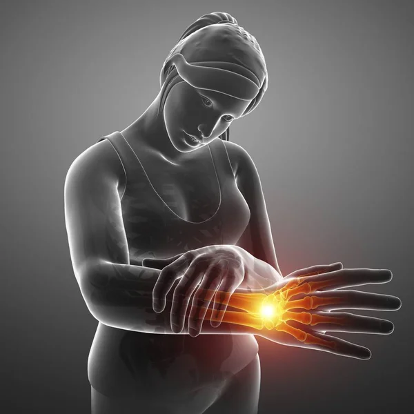 Female Silhouette Wrist Pain Digital Illustration — Stock Photo, Image