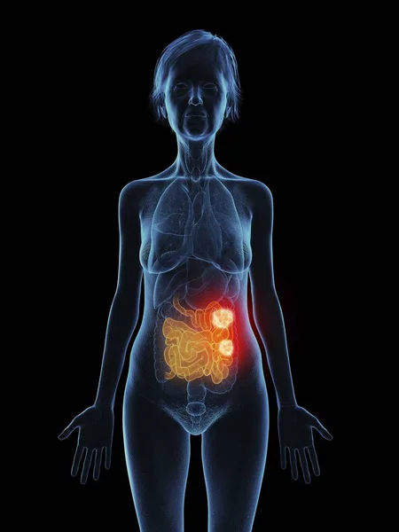 Ilustração Mulher Idosa Com Tumor Intestino Delgado Fundo Preto — Fotografia de Stock