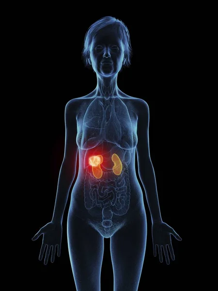 黒い背景に腎臓腫瘍と年配の女性のイラスト — ストック写真