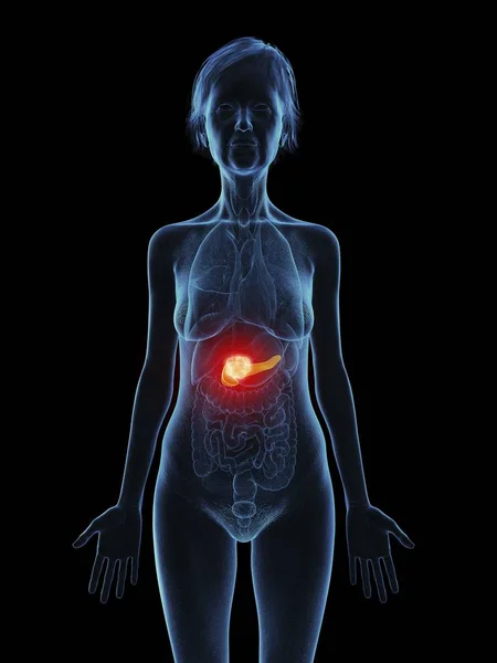 膵臓腫瘍と年配の女性のシルエットのイラスト — ストック写真