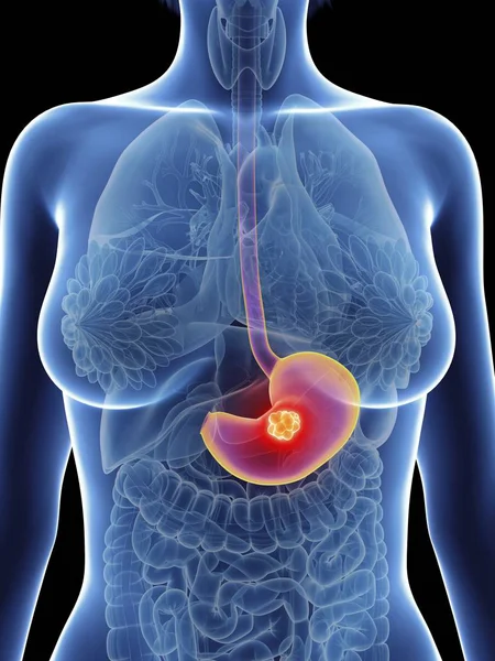 強調表示された胃がんと女性のシルエットのイラスト — ストック写真