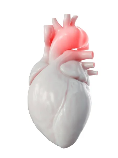 Illustration Von Aortenaneurysma Menschlichen Herzen — Stockfoto