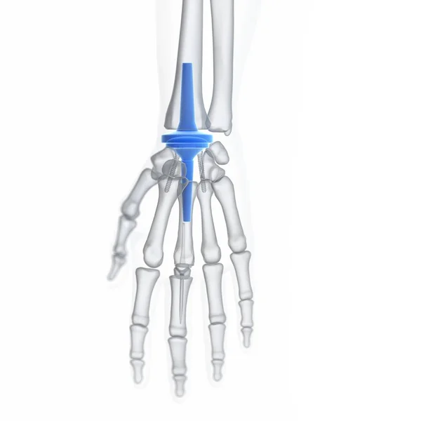 Иллюстрация Импланта Замены Запястья Белом Фоне — стоковое фото