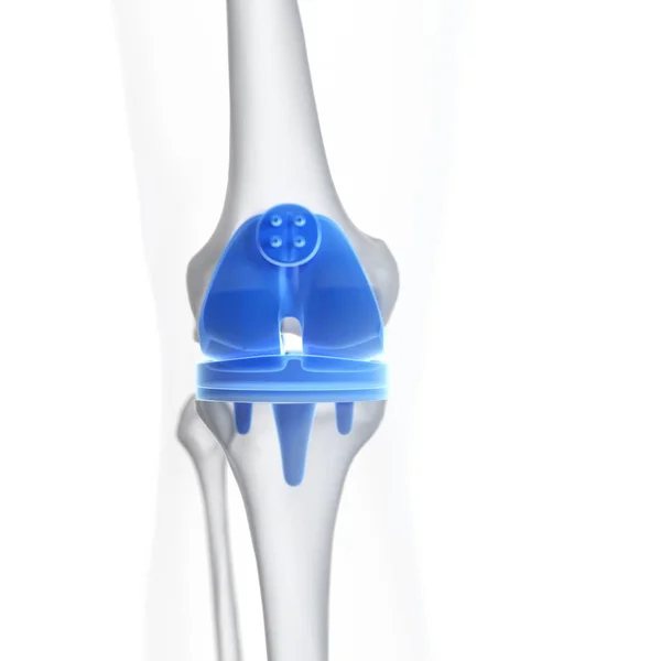 Illustration Des Knieersatzimplantats Auf Weißem Hintergrund — Stockfoto