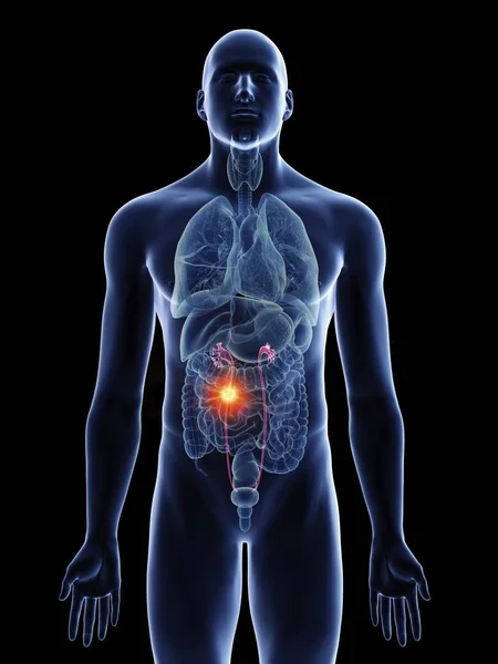 黒の背景に男性の体のシルエットに尿管癌のイラスト — ストック写真