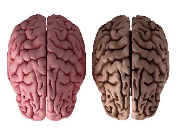 Ilustración Representada Cerebro Sano Insalubre Sobre Fondo Blanco — Foto de Stock