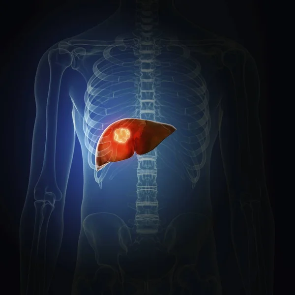 Illustration Liver Cancer Human Body Silhouette — Stock Photo, Image