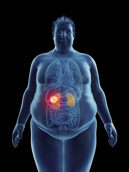 肥胖人剪影的例证与突出的肾脏肿瘤 — 图库照片