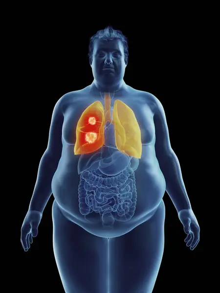 Illustrazione Della Silhouette Dell Uomo Obeso Con Tumore Polmonare Evidenziato — Foto Stock