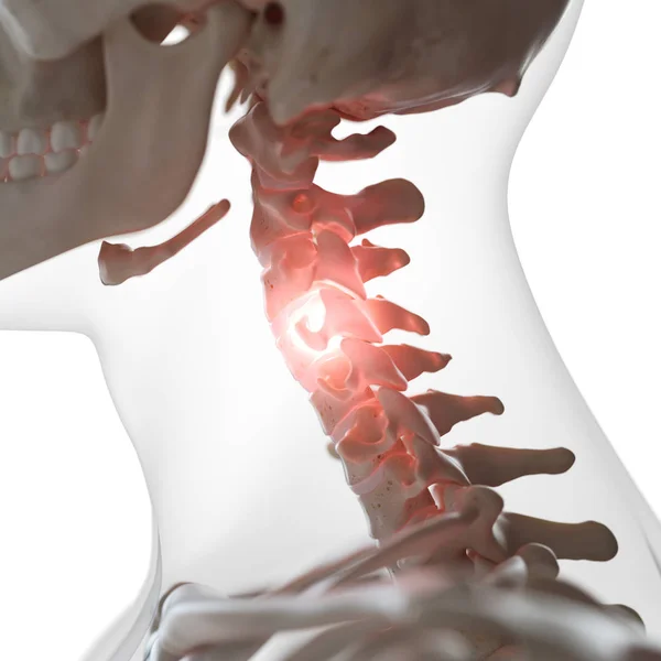 Digitale Illustration Der Schmerzhaften Halswirbelsäule Menschlichen Skelett — Stockfoto