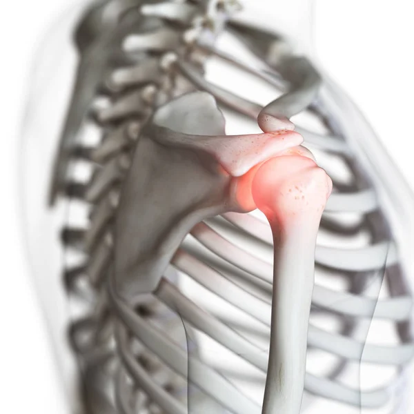 Digital Illustration Painful Shoulder Joint Human Skeleton — Stock Photo, Image