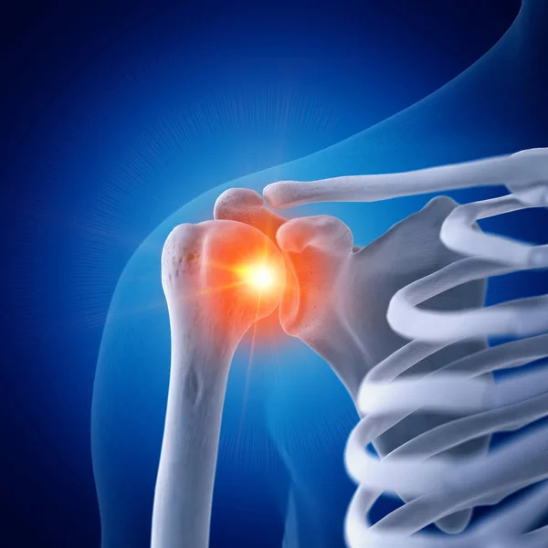 Illustration Der Schmerzhaften Schulter Menschlichen Skelett Auf Blauem Hintergrund — Stockfoto