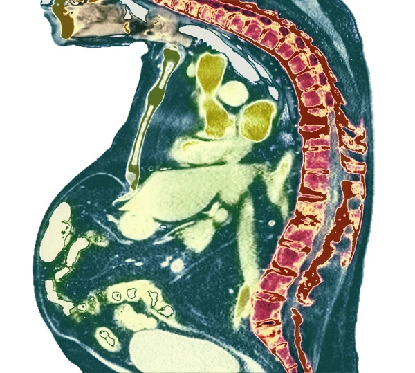 Farbiges Röntgenbild Der Brustwirbelsäule Eines Älteren Männlichen Patienten Mit Morbus — Stockfoto