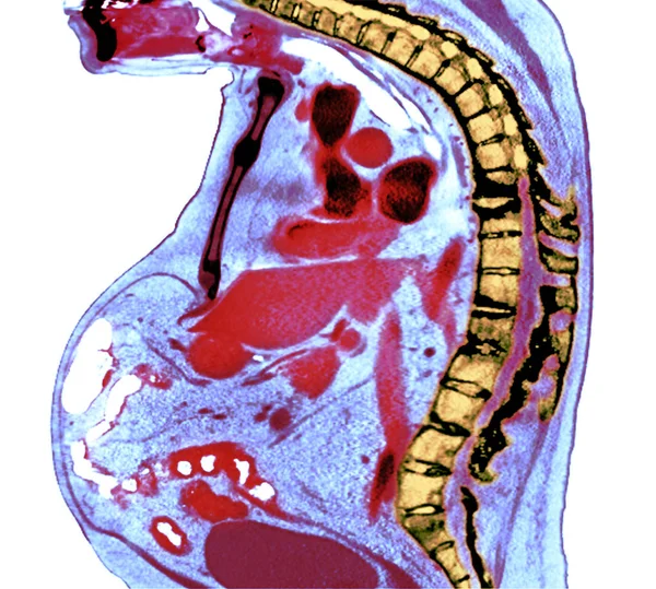 Цветной Рентген Сечения Грудного Отдела Позвоночника Пожилого Мужчины Анкилозирующим Спондилитом — стоковое фото