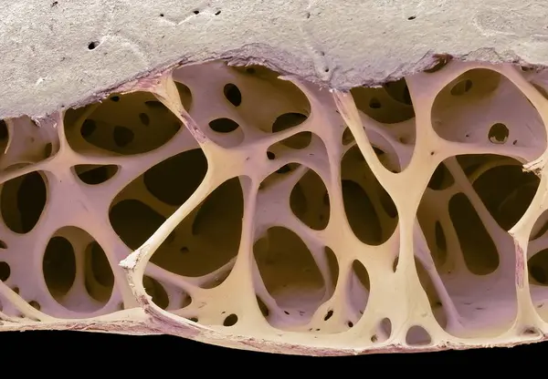 Micrographie Électronique Balayage Coloré Tissu Osseux Cancéreux Crâne Oiseau Étourdi — Photo