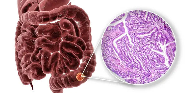 Рак Товстої Кишки Цифрова Ілюстрація Легкий Мікрограф Показує Аденокарциному Товстої — стокове фото