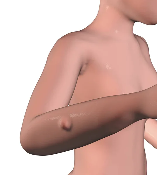 Lipoma Groei Van Vetweefsel Vrouwelijke Arm Huid Digitale Illustratie — Stockfoto