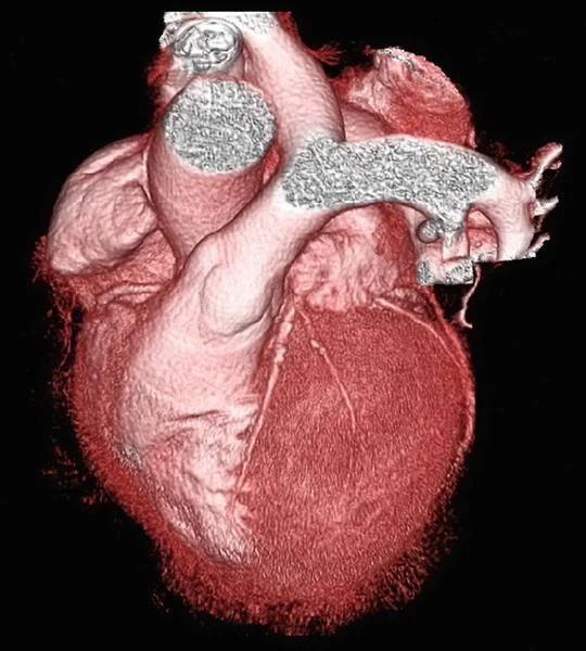 Здоровое Сердце Черном Фоне Трехмерная Компьютерная Томография — стоковое фото