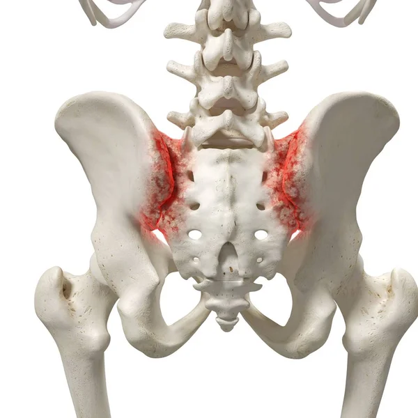 Realistic Digital Illustration Showing Arthritis Human Sacrum — Stock Photo, Image