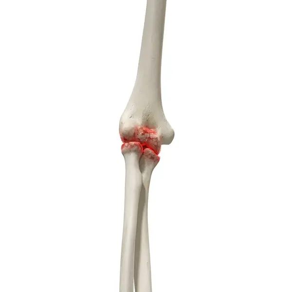 Ilustración Digital Realista Que Muestra Artritis Codo Humano — Foto de Stock