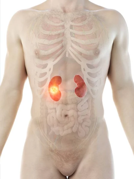 Kidney Cancer Male Body Conceptual Digital Illustration — Stock Photo, Image