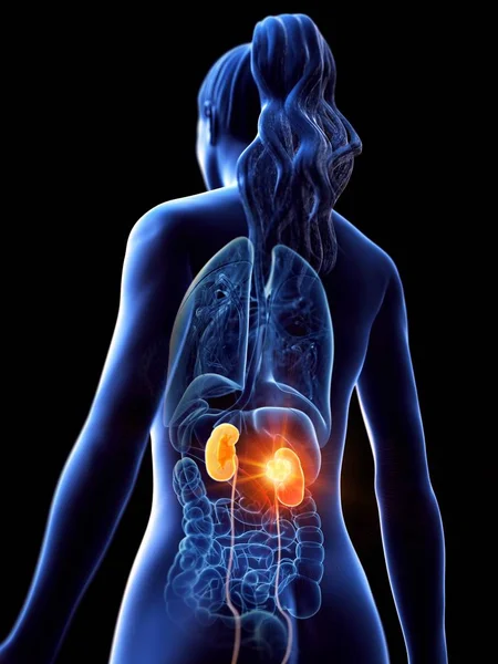 Vista Ángulo Bajo Mujer Con Tumor Renal Ilustración Por Computadora — Foto de Stock