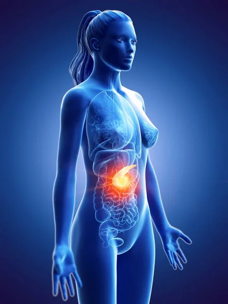 Pancreatic Cancer Female Body Conceptual Computer Illustration — Stock Photo, Image