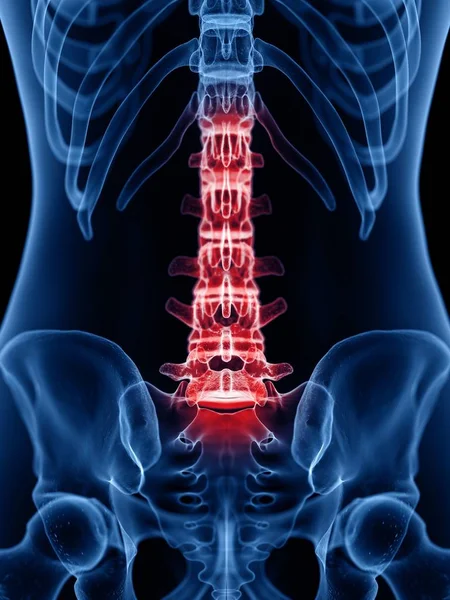 Human Silhouette Showing Back Pain Conceptual Illustration — Stock Photo, Image