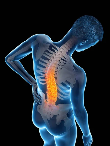 男性剪影与背部疼痛在高角度视图 概念插图 — 图库照片