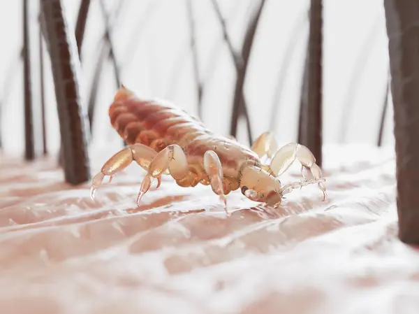 Parasitic Louse Human Head Skin Digital Illustration — Stock Photo, Image