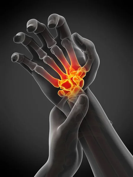 手部腕部疼痛发亮的男性手 概念说明 — 图库照片