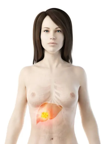 Leverkanker Realistisch Anatomisch Vrouwelijk Model Conceptuele Computer Illustratie — Stockfoto