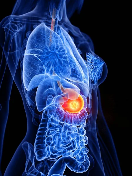 女性の体の胃癌 概念的なコンピュータイラスト — ストック写真